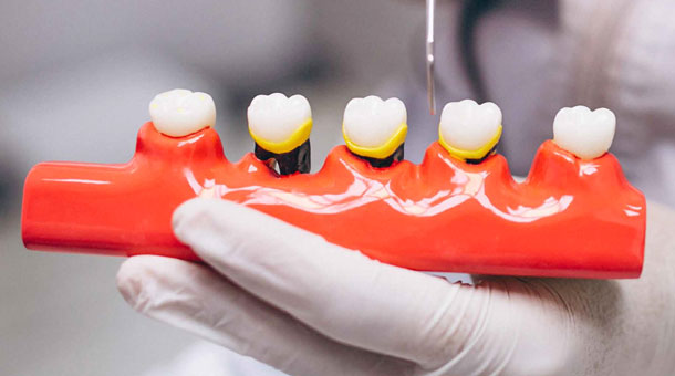 dental implant implementation